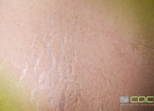 CACI stretch marks and scars