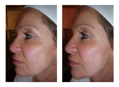 CACI Ultimate Anti-Aging Facial